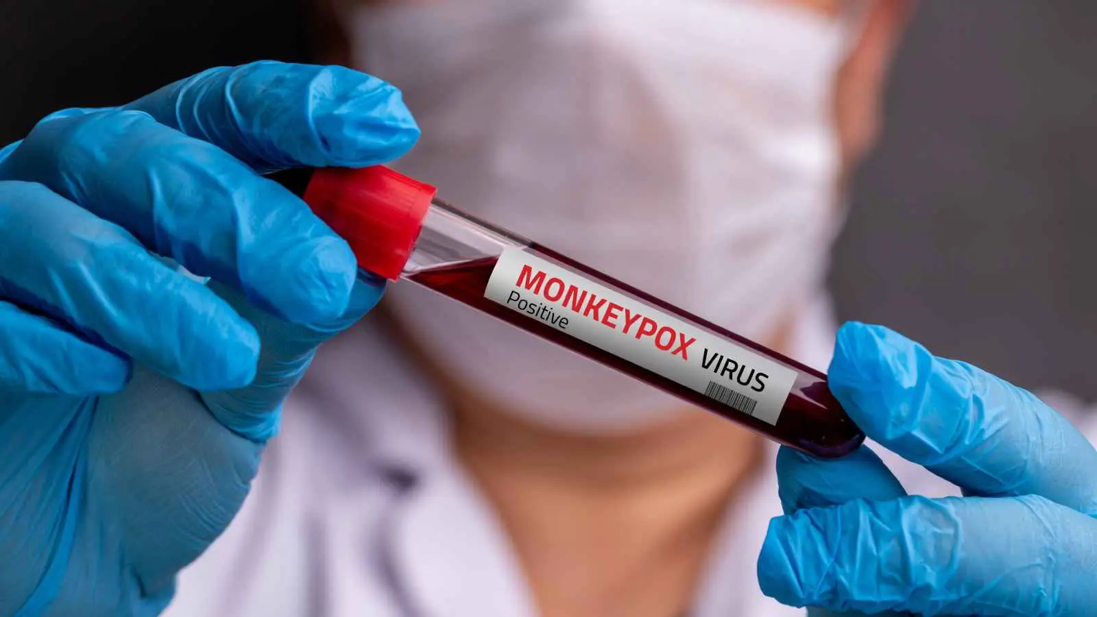 كندا تعلن عن اكتشاف أول حالة إصابة مؤكدة بجدري القردة